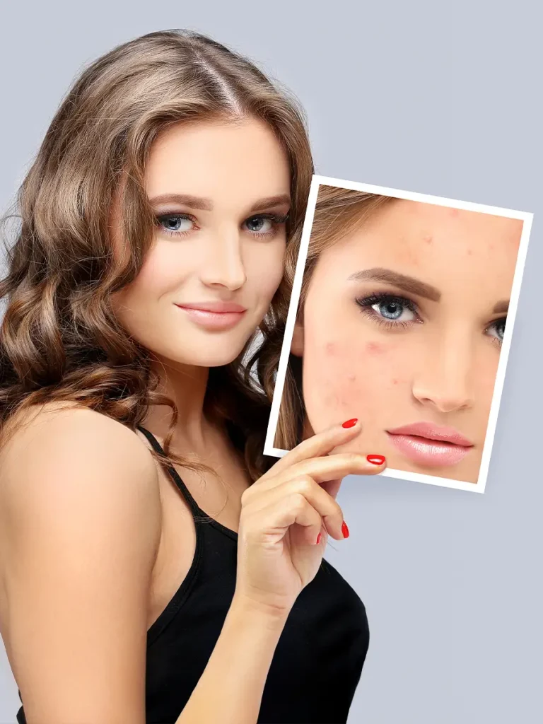 Acne and Pimple Treatment