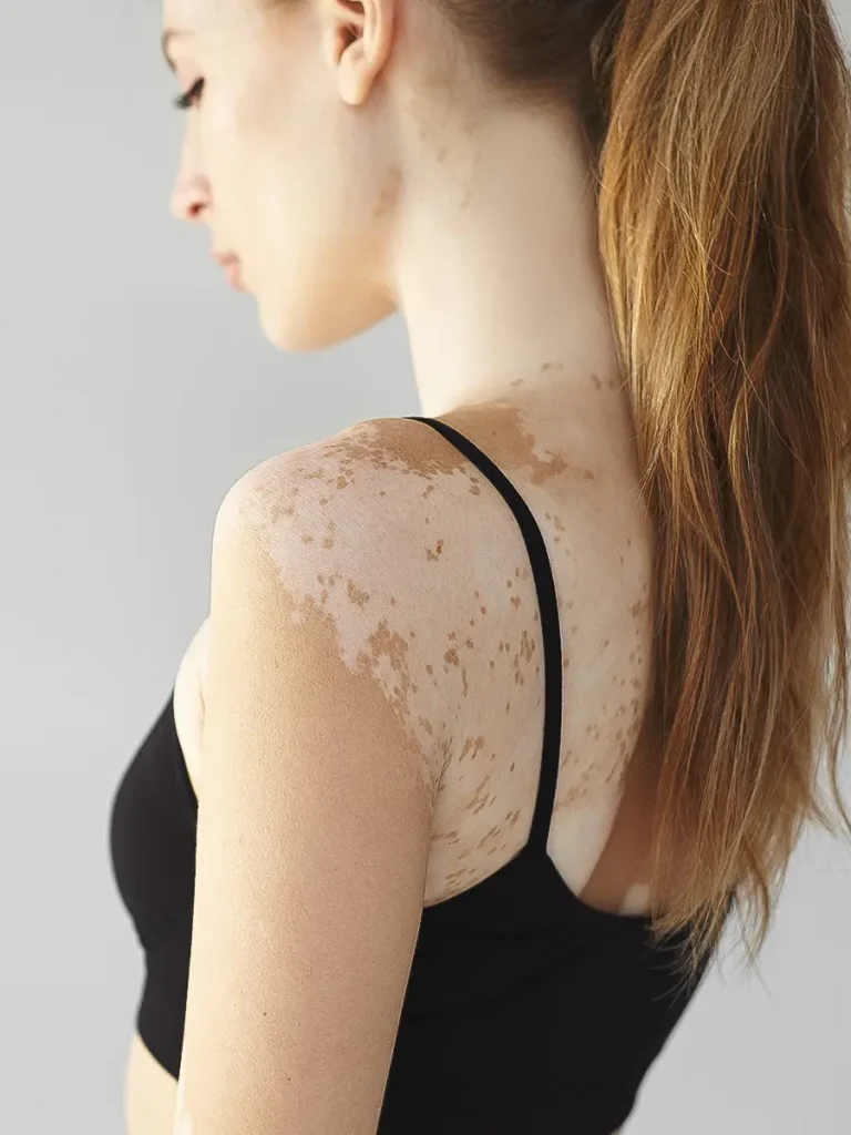 Fungal Infection Treatment