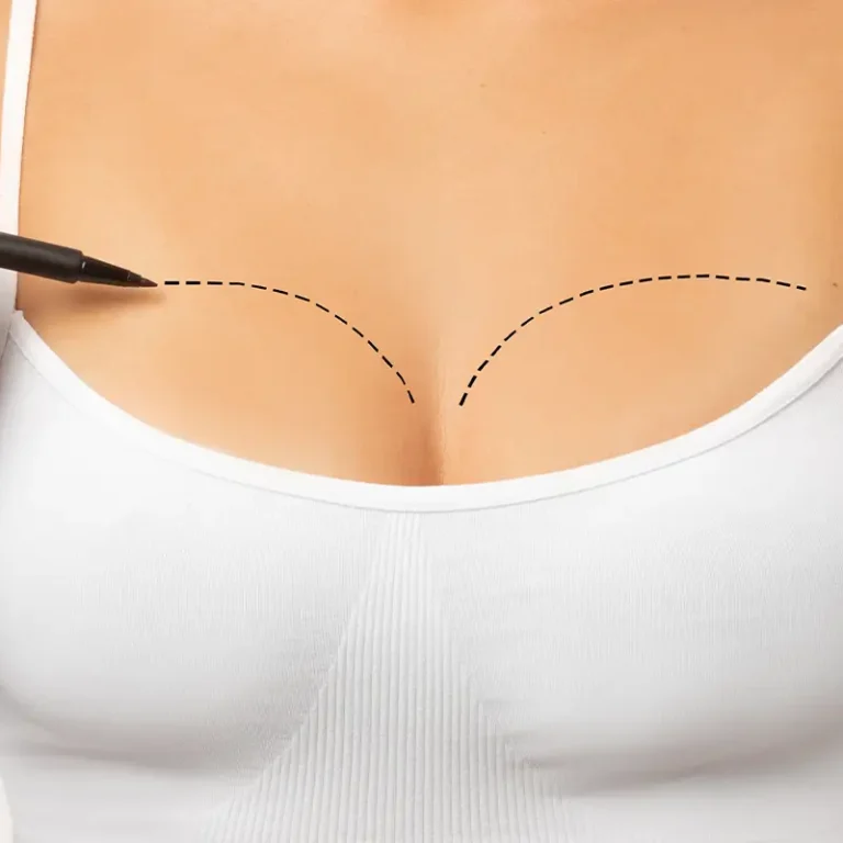 Breast Augmentation Surgery