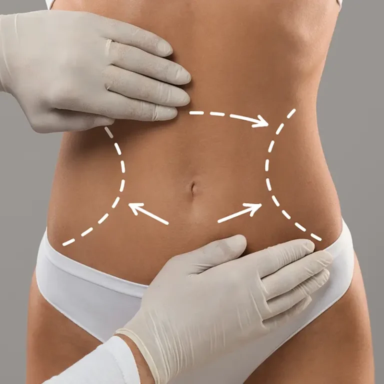 Liposuction