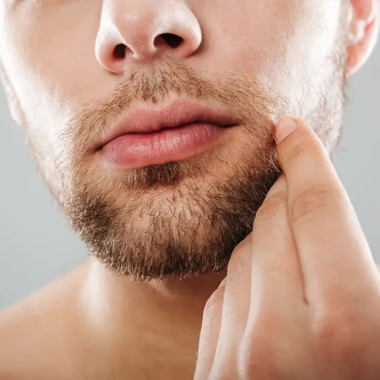 Beard & Mustache Transplant
