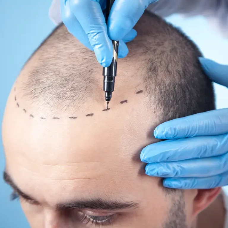 FUE Hair Transplantation